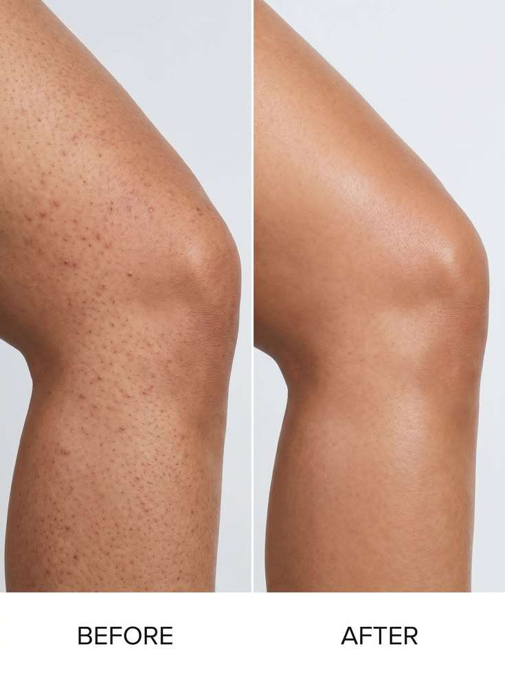 Photo &Eacute;pilation laser m&eacute;dicale et poils incarn&eacute;s : une solution efficace et durable